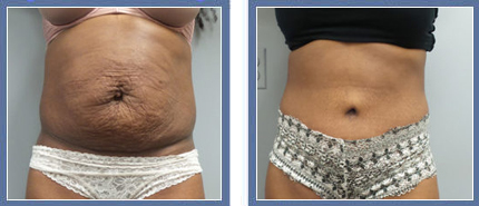 Abdominoplasty Before and After Photo